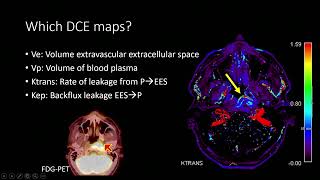 2022  Perfusion in the Head and Neck CT and MR  Remy Lobo [upl. by Romy508]