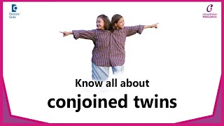 How are conjoined twins formed  How conjoined twins separated DrSamatha Kumar  Doctors Circle [upl. by Atnuhs690]