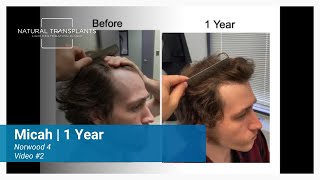 One Year Later Norwood 4 Incredible Hair Transformation Journey  Dr Blumenthal Micah [upl. by Argent]