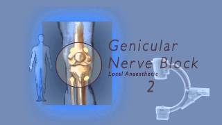 Genicular nerve block by Dr Murli Krishna Pain Specialist Bristol [upl. by Leor]