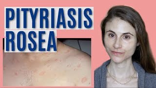 PITYRIASIS ROSEA WHAT IT IS amp GETTING RID OF IT DR DRAY [upl. by Eduj]