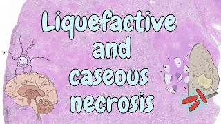 Liquefactive and caseous necrosis  general pathology [upl. by Evy965]