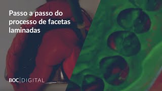 Vídeo 1 Passo a passo do processo de facetas laminadas [upl. by Noel]