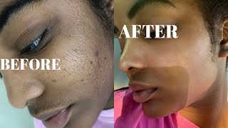 I SHAVED MY FACE  DERMAPLANING FULL PROCEDURE [upl. by Ahseital165]