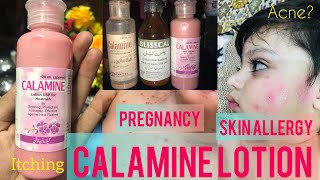 CALAMINE LOTION USES Skin Allergy Pregnancy Itching HeatRashbaby rashesreviewchicken poxance [upl. by Niamart]