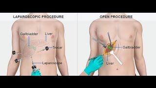 What are Gallstones Causes Symptoms  Treatment of Gallstone [upl. by Fredericka]