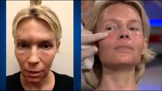 Dr Ourian Demonstrates Fractora  The Mini Face Lift [upl. by Liebman]