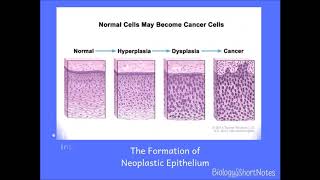 Metaplasia heteroplasia dysplasia neoplasia hyperplasia and anaplasia [upl. by Eirrol]