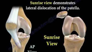 Patellar Dislocations  Everything You Need To Know  Dr Nabil Ebraheim [upl. by Neirrad]