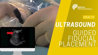 Ultrasound Guided Fiducial Placement for Stereotactic Radiotherapy [upl. by Kong]