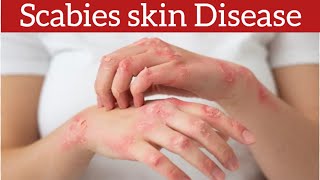 Scabies Signs Symptoms Causes and Treatment [upl. by Ahsenahs581]