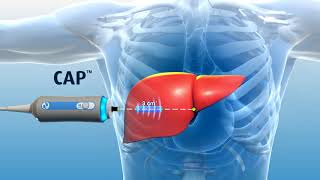 A patients introduction to FibroScan  Ohio State Medical Center [upl. by Dahraf]