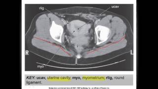 The Pelvis CT Anatomymp4 [upl. by Aicileb]