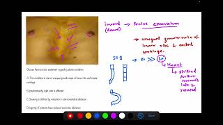 Congenital Chest Wall deformity based on Sabiston textbook of Surgery MCQ based [upl. by Canute]