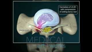 3D Medical Animation  L5S1paracentraldischerniation with compression of nerve root [upl. by Fahey823]