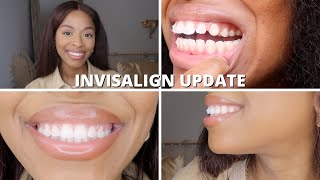 7 MONTH INVISALIGN UPDATE  INVISALIGN BEFORE AND AFTER [upl. by Trovillion38]