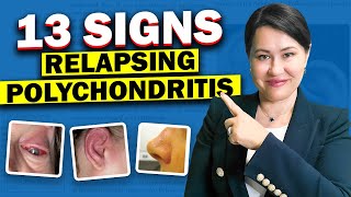 13 Top Signs of Relapsing Polychondritis [upl. by Geiger690]