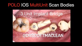 PoLo Scan Bodies  3 Unit Implant Bridge [upl. by Arada]