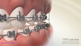 Elastics  Crossbite  Orthodontic Treatment [upl. by Ytsrik772]