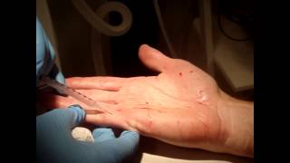 Dr Patrick Treacy demonstrates Botox for Sweaty Palms [upl. by Aleb]