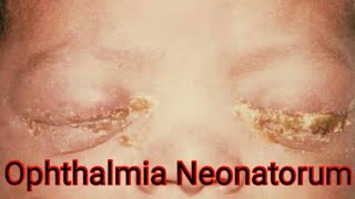 Ophthalmia Neonatorum Neonatal Conjunctivitis causes Treatment [upl. by Ynove]