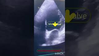 Echocardiography in LVH with mitral valve [upl. by Anividul]