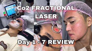 CO2 Fractional Laser Review DAY 1  7 [upl. by Akemet]