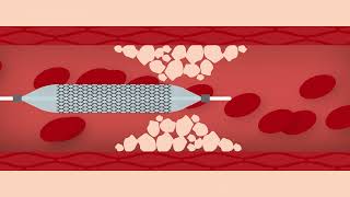 Heart Stent Procedure [upl. by Kelwen]