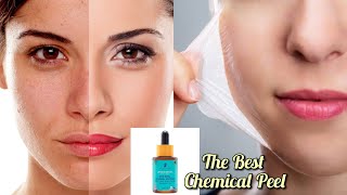 The Best Chemical Peel Review  Pilgrim  Care Lock [upl. by Jeri]