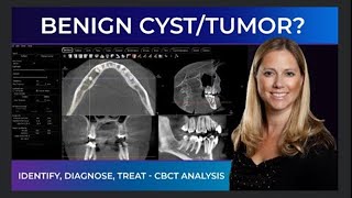 Case Bites  Identifying a Benign CystTumor with CBCT [upl. by Yrmac]