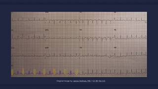 Electrical Alternans ECG [upl. by Chisholm431]