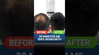 30 Minutes Me full density  Hair Loss  Hair fall  Hair regrowth Adon Hair Care viral shorts [upl. by Ttenaej]