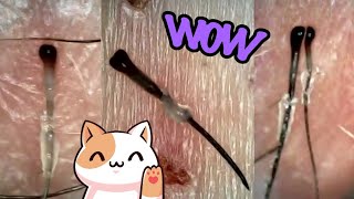 Juicy Hair Follicle Plucks Under The Microscope Super Satisfying [upl. by Issi940]