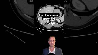 Abdominal CT Tutorials  Find the Normal Appendix [upl. by Baptlsta]