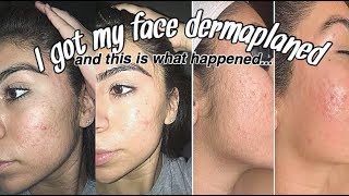 DERMAPLANING BEFORE AND AFTER with footage [upl. by Emiaj]