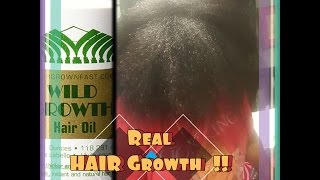 I was So baldhead 😓😭 Wild Growth Oil detailed Review ep1 ♡ [upl. by Asirehc796]