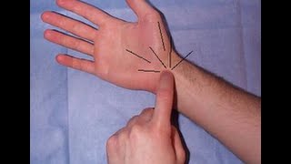 Easy SelfTests for Wrist Tendonitis [upl. by Ellerehc]