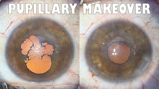 Pupillary makeover tilt and chop cough attack [upl. by Cowen756]