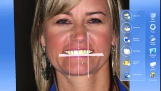 CEREC 42 Smile Design [upl. by Niai]