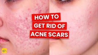 How To Get Rid of Acne Scars  Credihealth [upl. by Keverian]