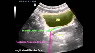 Stone at distal part of the ureter [upl. by Meerak]