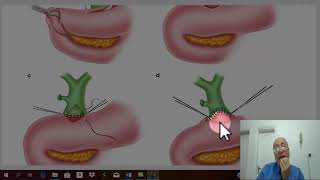 Biliary surgery 19  Obstructive jaundice  part 7   by Dr Wahdan [upl. by Navonoj]