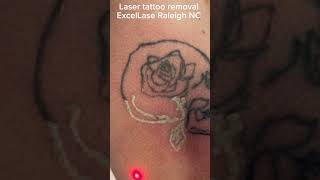 Laser removal of a not so scary skeleton tattoo tattooremoval lasertattooremoval satisfying [upl. by Gretel]