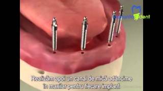 Implants Mini Implant Overdenture Procedure [upl. by Whiffen890]