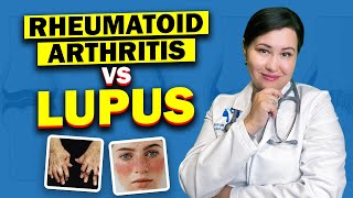 Rheumatoid Arthritis And Lupus At The Same Time [upl. by Ielarol]