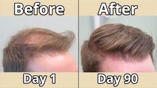 How To Fully Regrow amp Stop Hair Loss In 2024 Full Guide [upl. by Matilde]