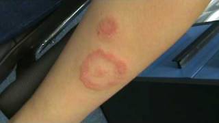 SCARY RINGWORM ON GIRLS ARM [upl. by Nosa357]