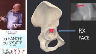 Comment lire une radio de hanche les 3 types de coxarthrose Extraits Dr Baur journée SMATSH [upl. by Nannah]