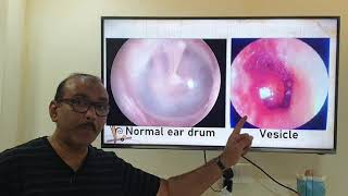 Bullous Myringitis Hindi Patient teaching programme [upl. by Ahsenal]