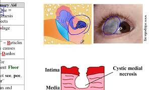 USMLE ACE Video 25 Collagen Synthesis and Disorders Types IIV and FibrillinRelated Conditions [upl. by Ibby572]